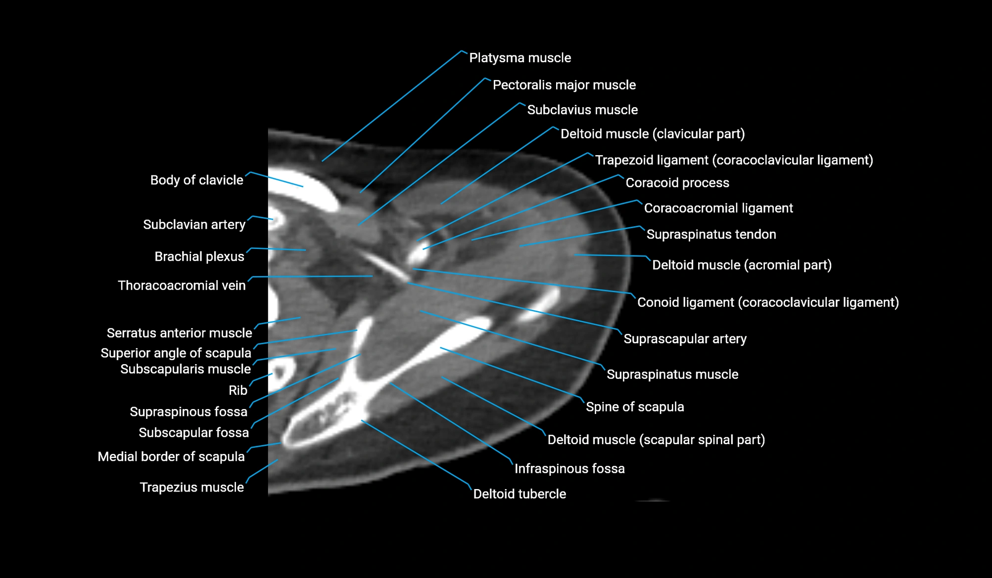 CT upper arm axial  cross sectional anatomy labelled radiology image -00072.webp